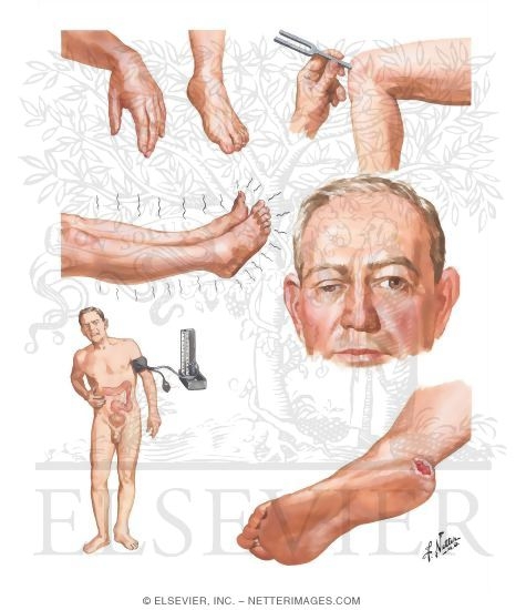 Watermarked preview of unlabeled image: Diabetic Neuropathy