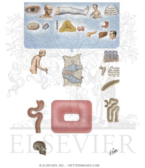 Watermarked preview of unlabeled image: Osteoporosis