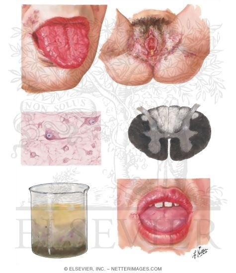 Pellagra