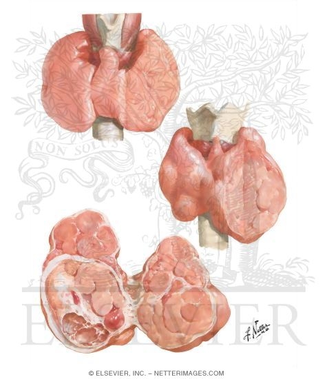 Watermarked preview of unlabeled image: Gross Pathology of Goiter