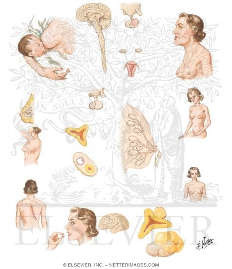 Galactorrhea