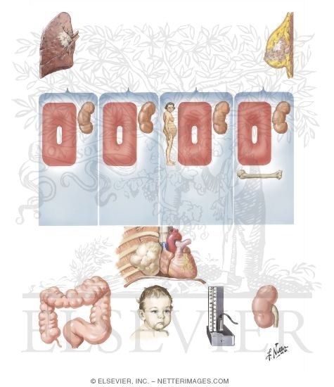 Watermarked preview of unlabeled image: Malignancies with Hormonal Secretions