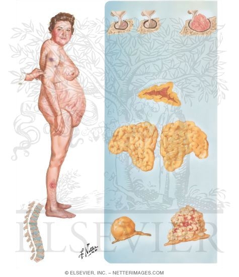 Watermarked preview of unlabeled image: Signs and Causes of Cushing's Syndrome