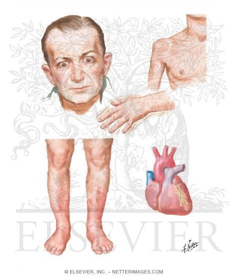 Graves Disease (Continued)