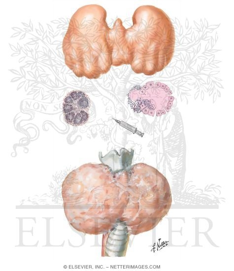 Watermarked preview of unlabeled image: Chronic Lymphocytic Thyroiditis and Fibrous Thyroiditis