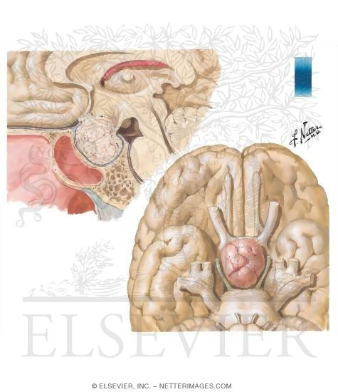 Watermarked preview of unlabeled image: Clinically Nonfunctioning Pituitary Tumor