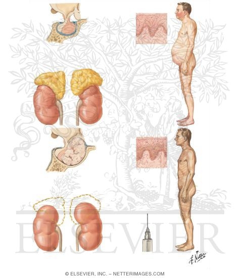 Nelson's Syndrome