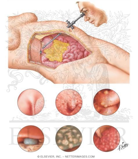 Watermarked preview of unlabeled image: Peritoneoscopy