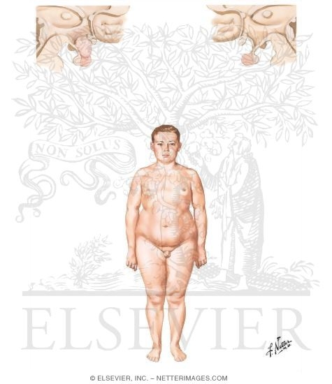 Adiposogenital Dystrophy: Usually A Self-Limited Functional Disorder