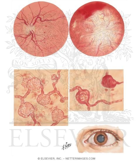 Watermarked preview of unlabeled image: Diabetic Retinopathy and Cataract