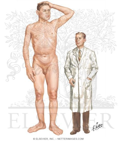 Gigantism