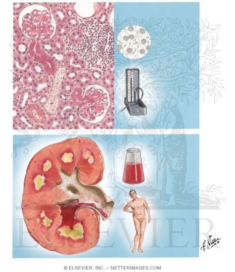 Watermarked preview of unlabeled image: Diabetic Nephropathy and Necrotizing Papillitis