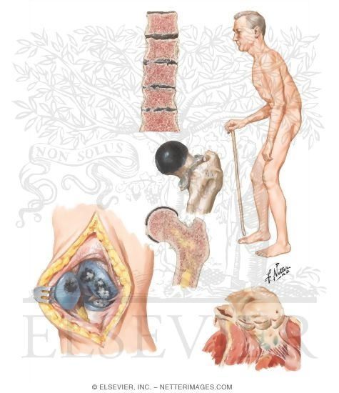 Ochronosis