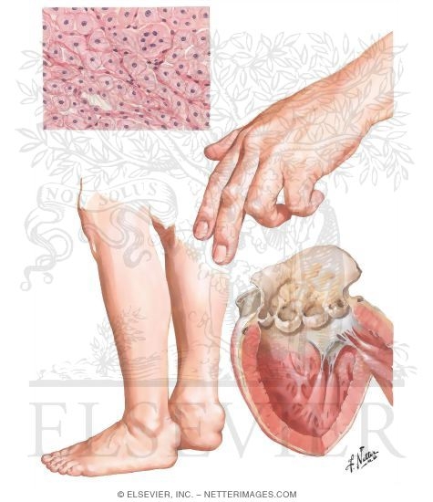 Watermarked preview of unlabeled image: Hypercholesterolemic Xanthomatosis - Plain and Tuberous Xanthoma