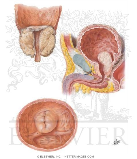 Watermarked preview of unlabeled image: Benign Prostatic Hypertrophy II