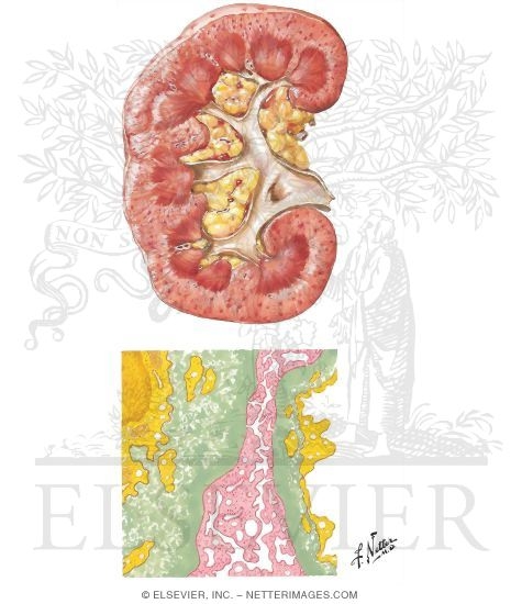 Watermarked preview of unlabeled image: Radiation Effects on the Kidney