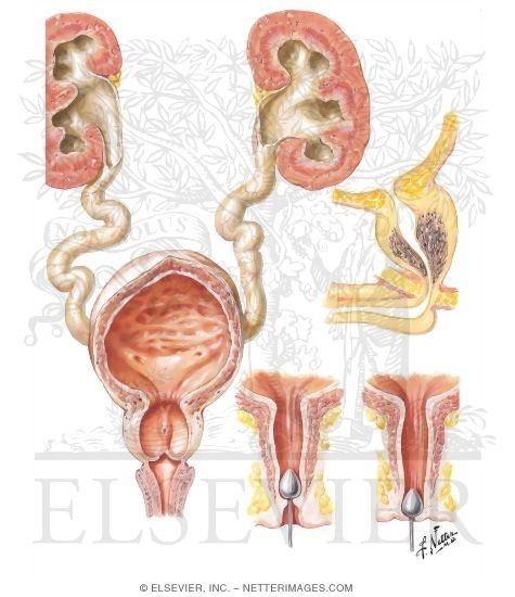 Congenital Bladder Outlet Obstruction