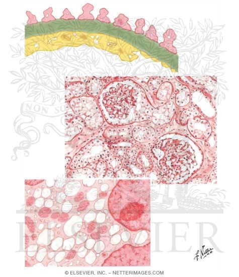 Watermarked preview of unlabeled image: Acute Renal Failure