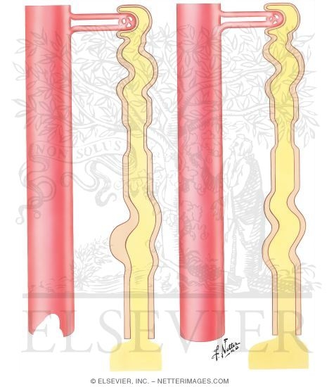 Watermarked preview of unlabeled image: Diuretics - Ethacrynic Acid, Furosemide; Osmotic Diuretics