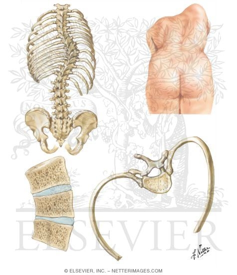 Pathologic Anatomy of Scoliosis