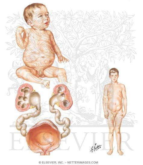 Absent Abdominal Musculature: 