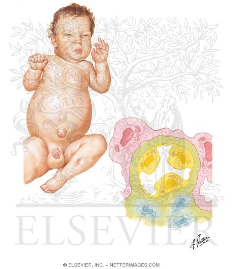 Watermarked preview of unlabeled image: Infantile Nephrosis