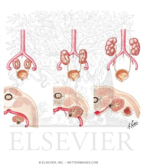 Ascent and Rotation of the Metanephric Kidneys