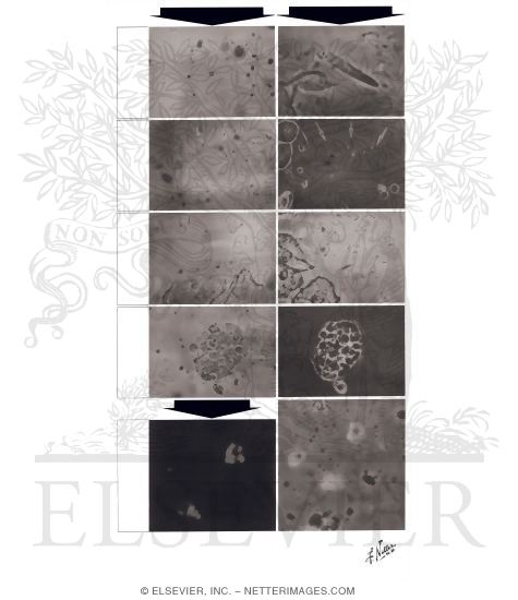 Watermarked preview of unlabeled image: Microscopic Urine Examination - Bright Light, Phase Contrast, and Polarized Light Microscopy