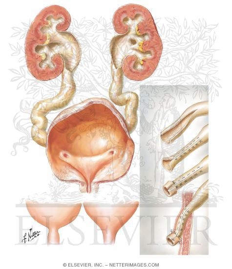Megacystis (Megaureter) Syndrome