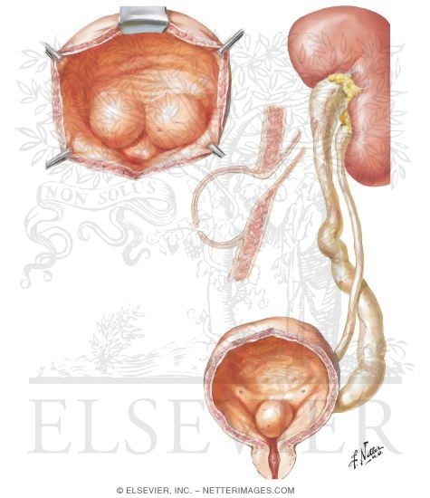 Ureterocele