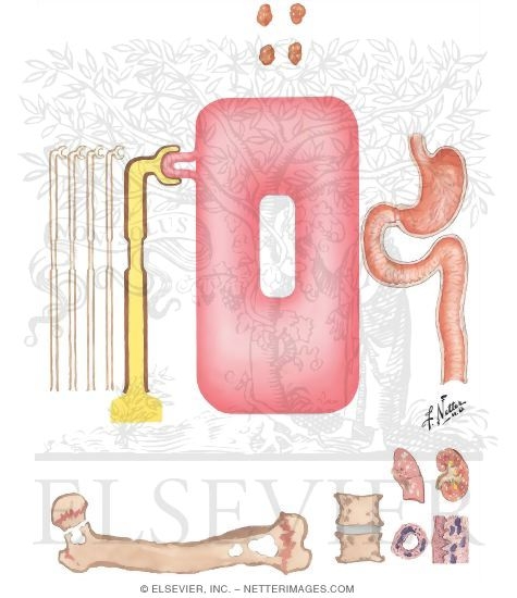 Watermarked preview of unlabeled image: Renal Failure: Calcium and Phosphorus Metabolism