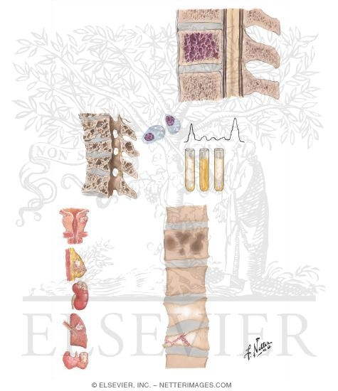Vertebral Column Tumors 