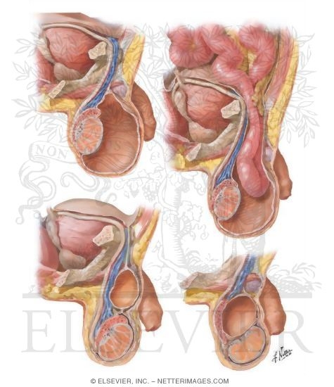 Hydrocele Spermatocele