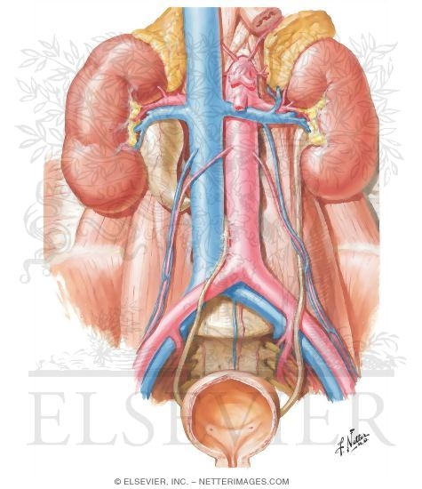 Retrocaval Ureter