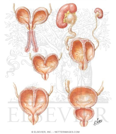 Duplication and Septa of the Bladder