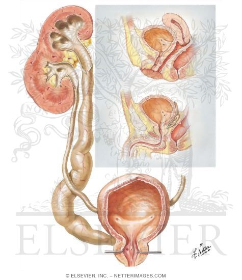 Ectopic Ureters