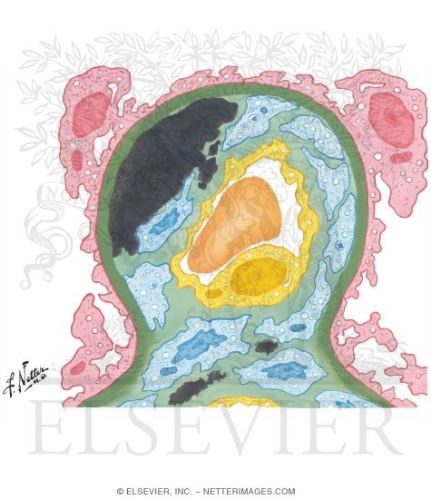 Watermarked preview of unlabeled image: Chronic Glomerulonephritis