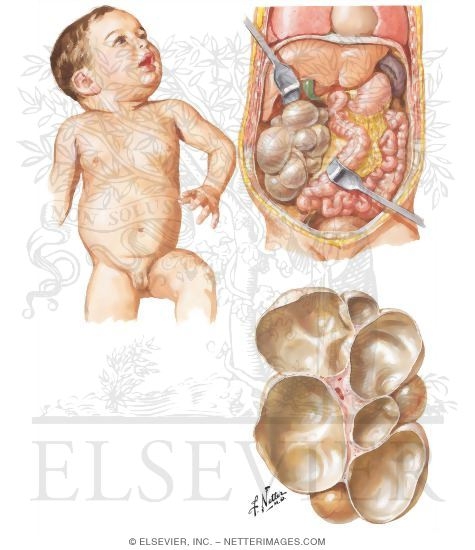 Watermarked preview of unlabeled image: Unilateral Multicystic Kidney