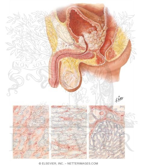 Watermarked preview of unlabeled image: Carcinoma of Prostate I - Types and Extension