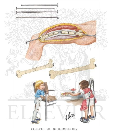 Treatment of Osteogenesis Imperfecta by Intramedullary Fixation and Orthoses