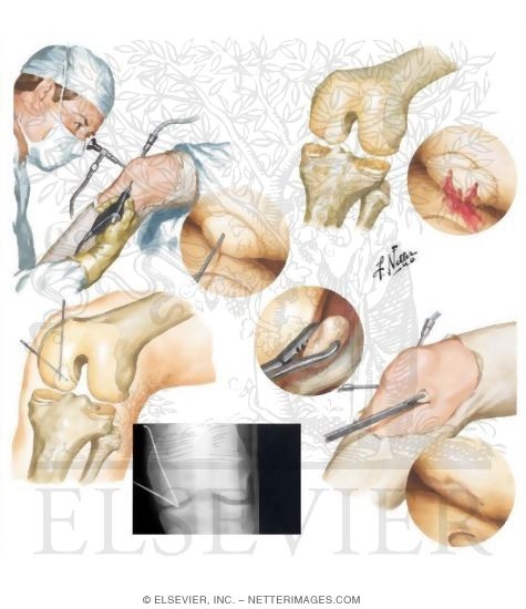 Watermarked preview of unlabeled image: Osteochondritis Dissecans
Anthroscopic Treatments