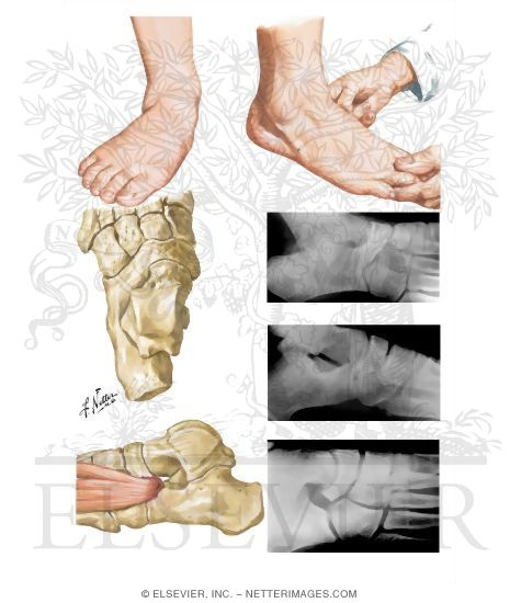 Tarsal Coalition Pediatric Disorders Of The Foot And Ankle - 