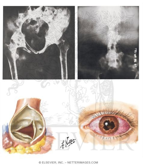 Ankylosing Spondylitis