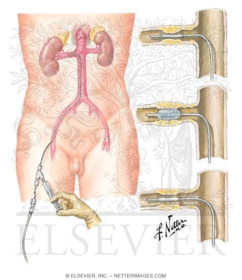 Transluminal Renal Angioplasty