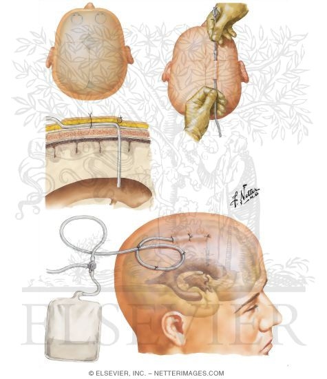 Watermarked preview of unlabeled image: Ventriculostomy