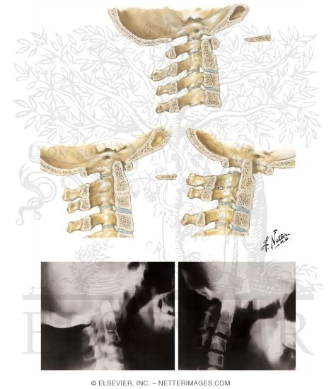 Watermarked preview of unlabeled image: Congenital Anomalies of Occipitocervical Junction