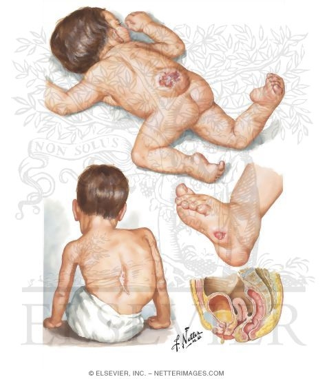 Watermarked preview of unlabeled image: Myelodysplasia