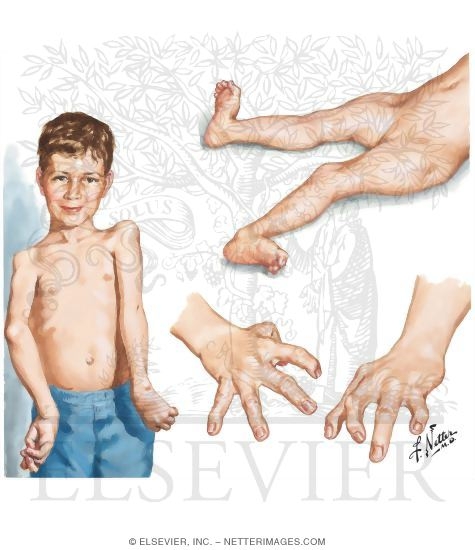 Arthrogryposis Multiplex Congenita