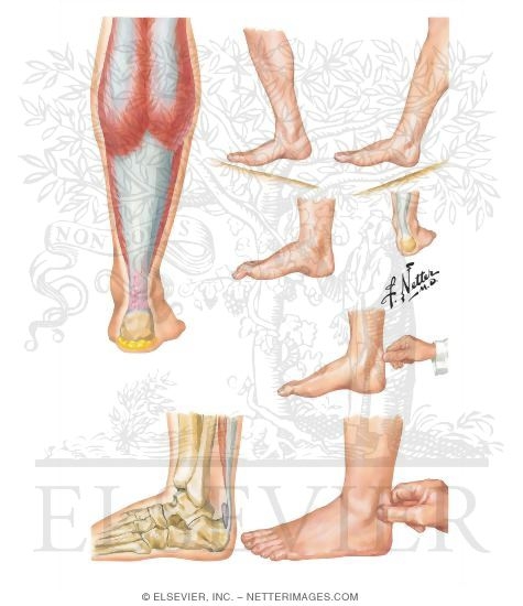 Achilles Tendinitis: Retrocalcaneal Bursitis