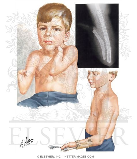 Failure of Formation of Parts: Longitudinal Arrest (Ulnar deficiency paraxial ulnar hemimelia)